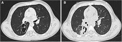 Chemotherapy-induced cavitating Wilms' tumor pulmonary metastasis: Active disease or scarring? A case report and literature review